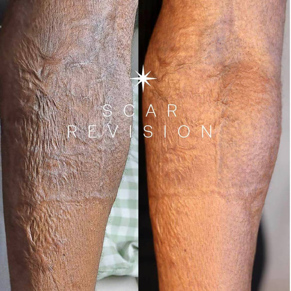 Scar Revision