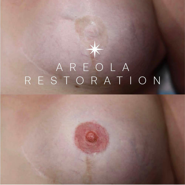 Areola Tattoo Reconstruction