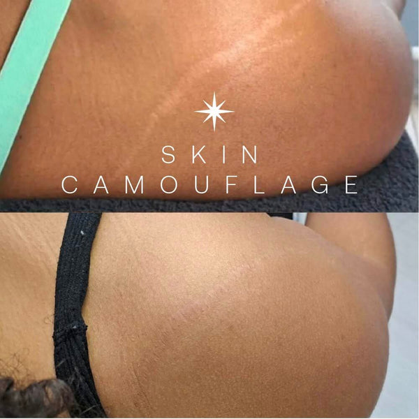Skin Camouflage