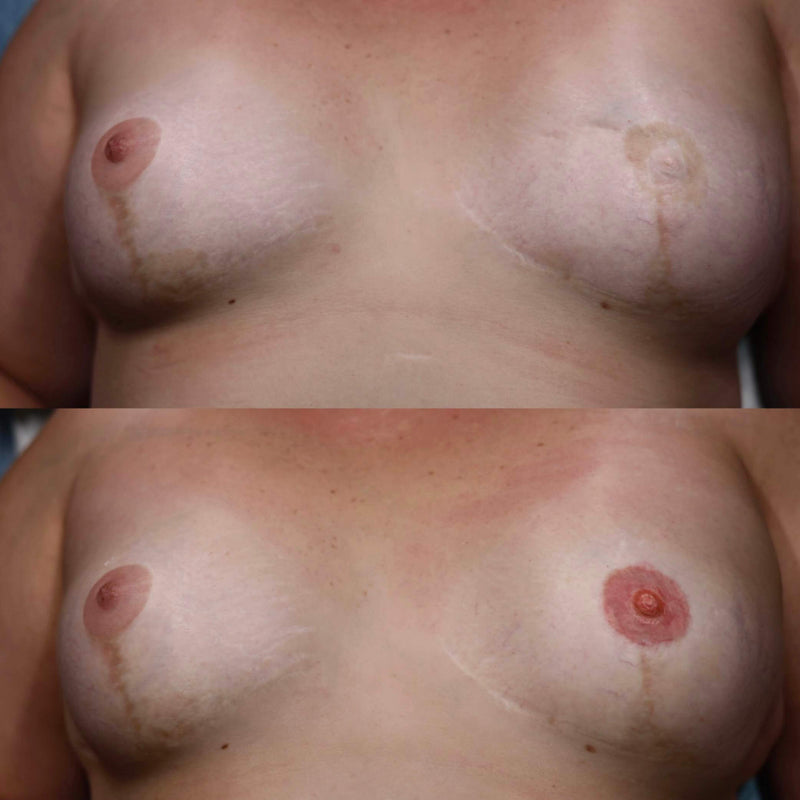 Areola Tattoo Reconstruction
