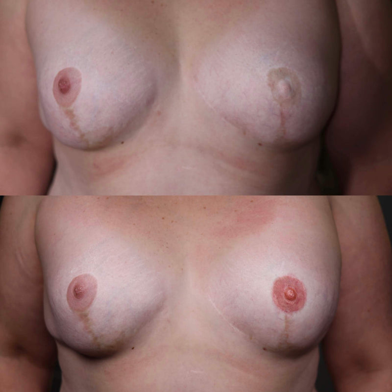 Areola Tattoo Reconstruction