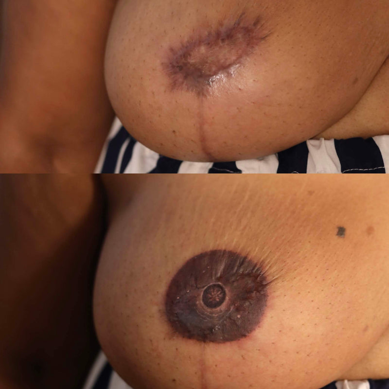 Areola Tattoo Reconstruction