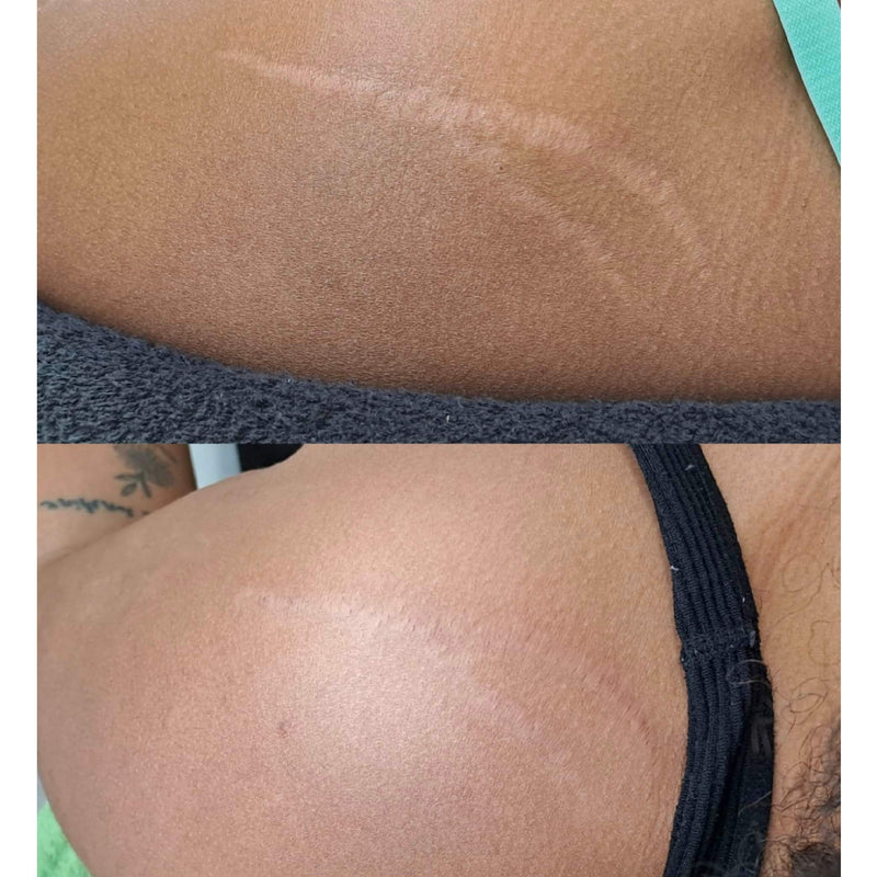 Skin Camouflage