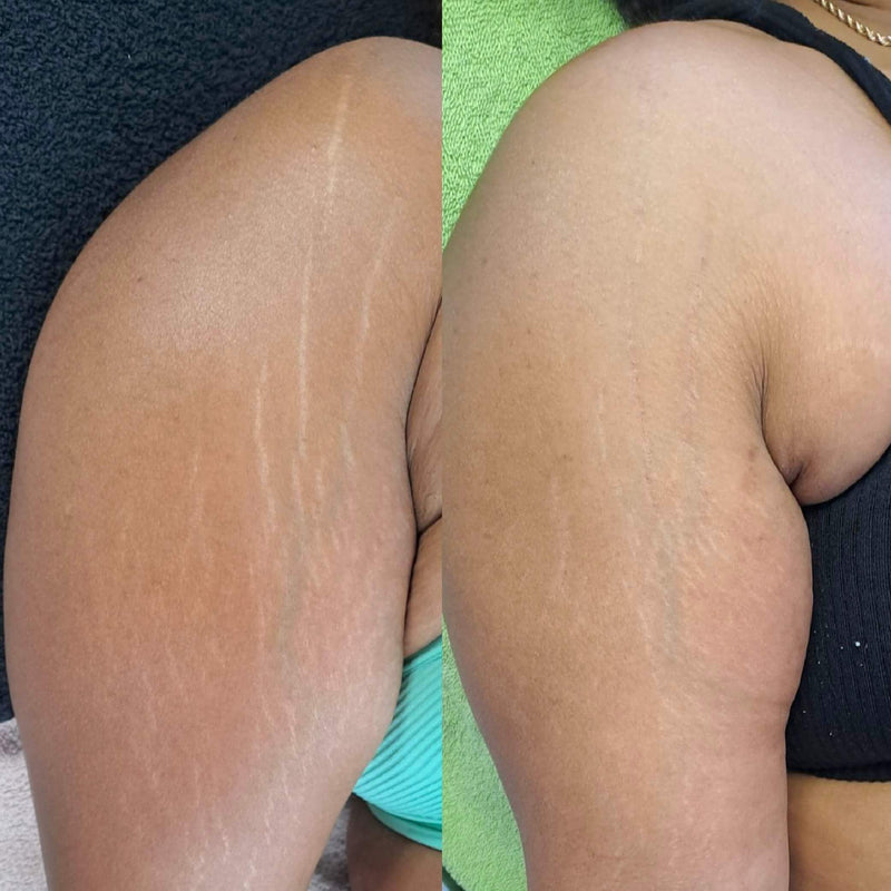 Skin Camouflage