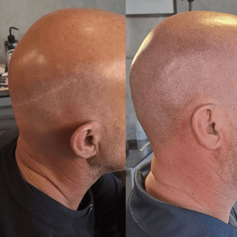 Micro-Pigmentation