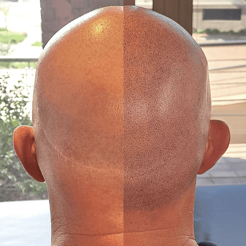 Micro-Pigmentation