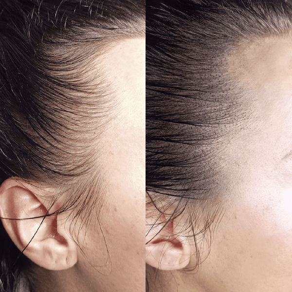 Micro-Pigmentation