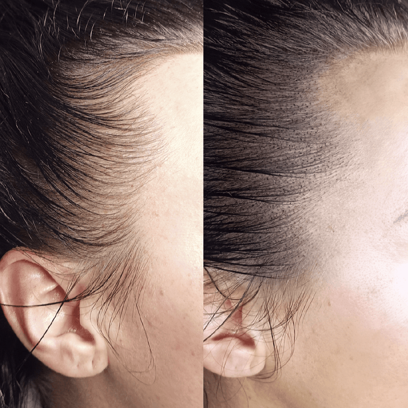 Micro-Pigmentation