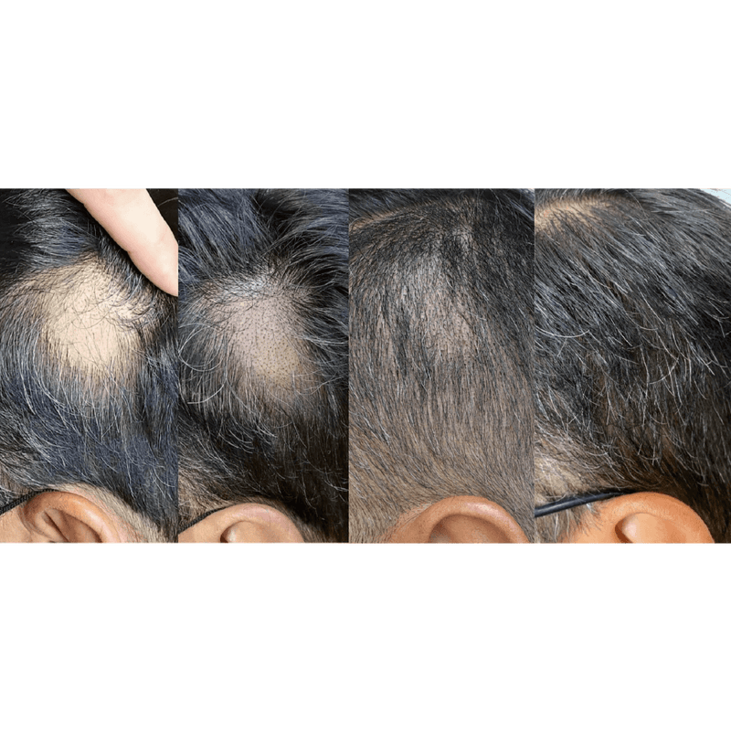 Micro-Pigmentation