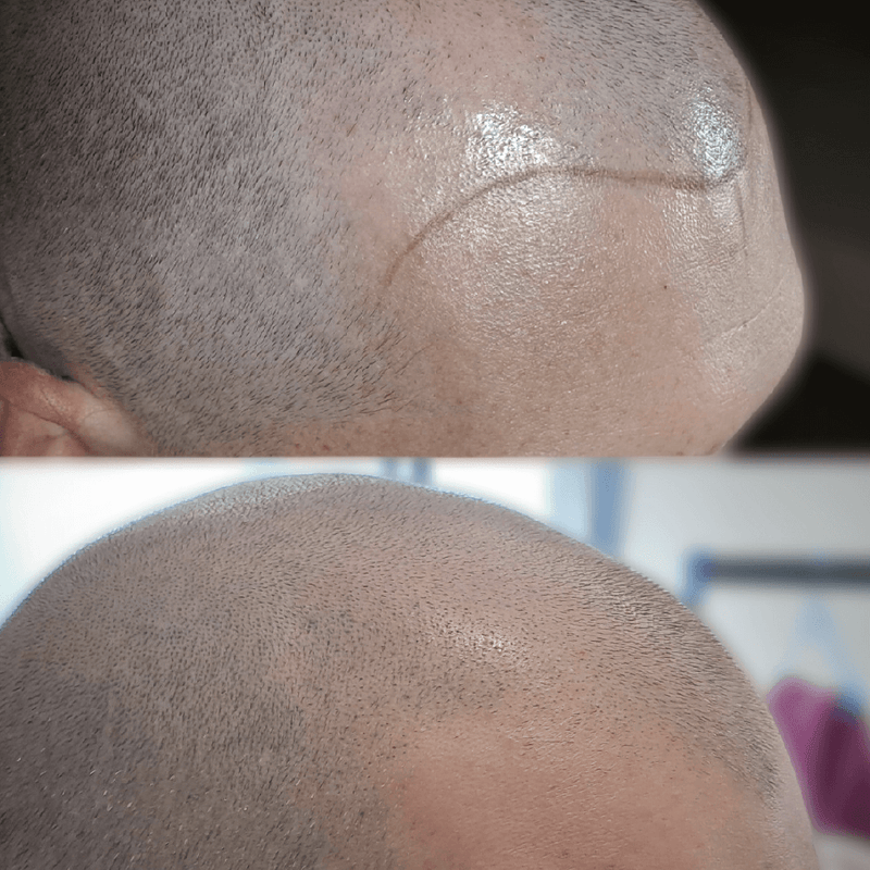 Micro-Pigmentation