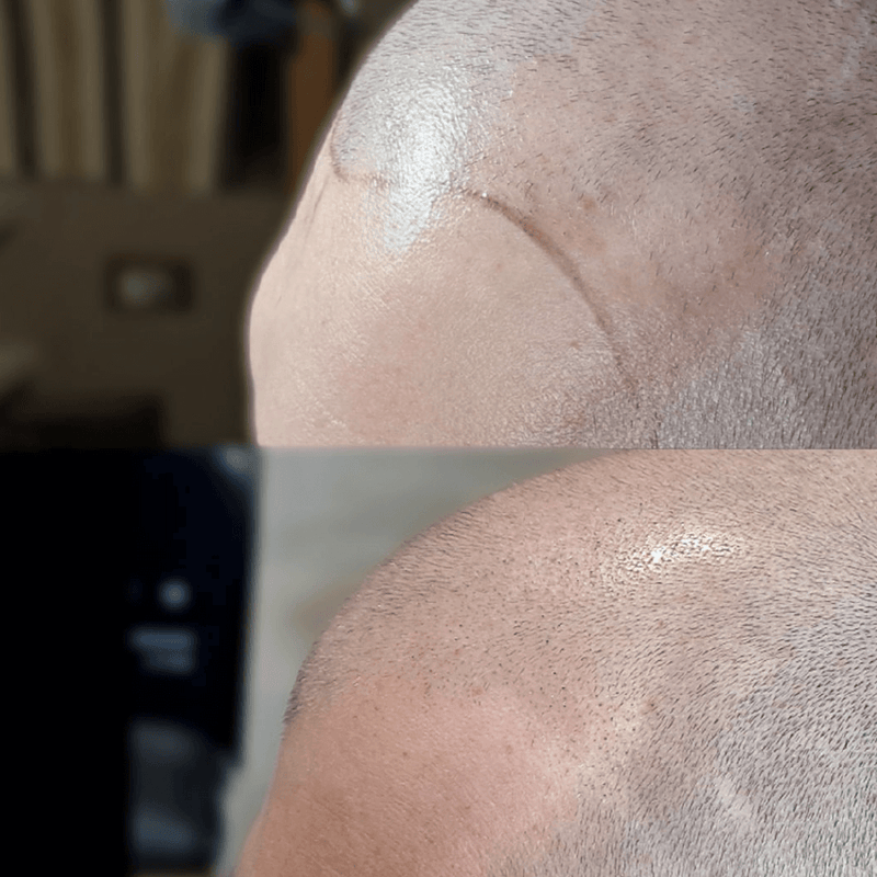 Micro-Pigmentation