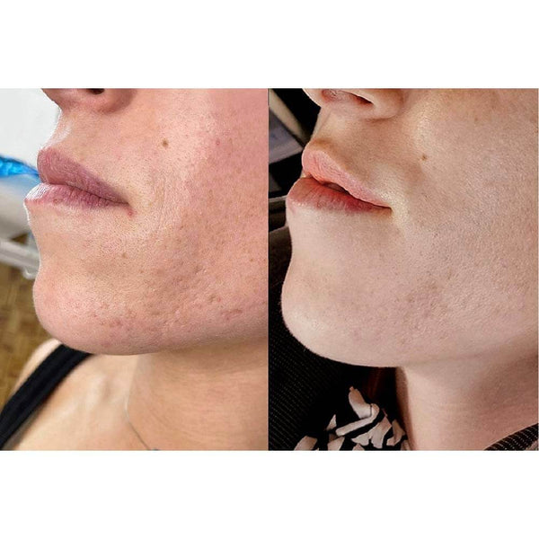 Scar Revision