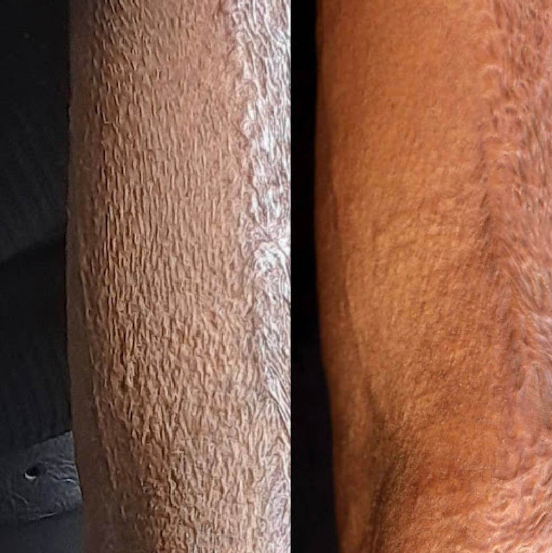 Scar Revision